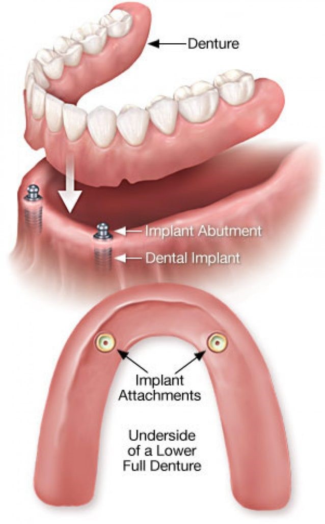 Locator Attachments For Dentures Flora LA 71428